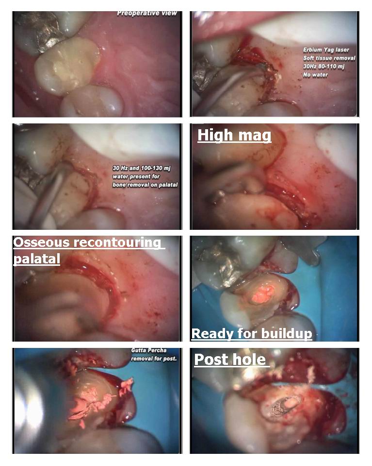 Page 1 of osseous recontouring.jpg